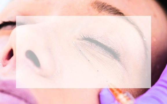 TEAR TROUGH FILLER Patient having treatment