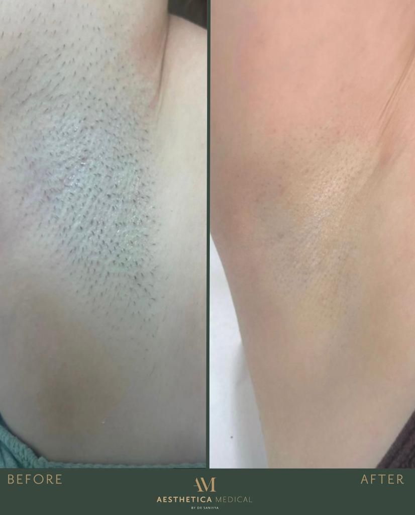 Laser Hair Removal Leeds Hair removal service