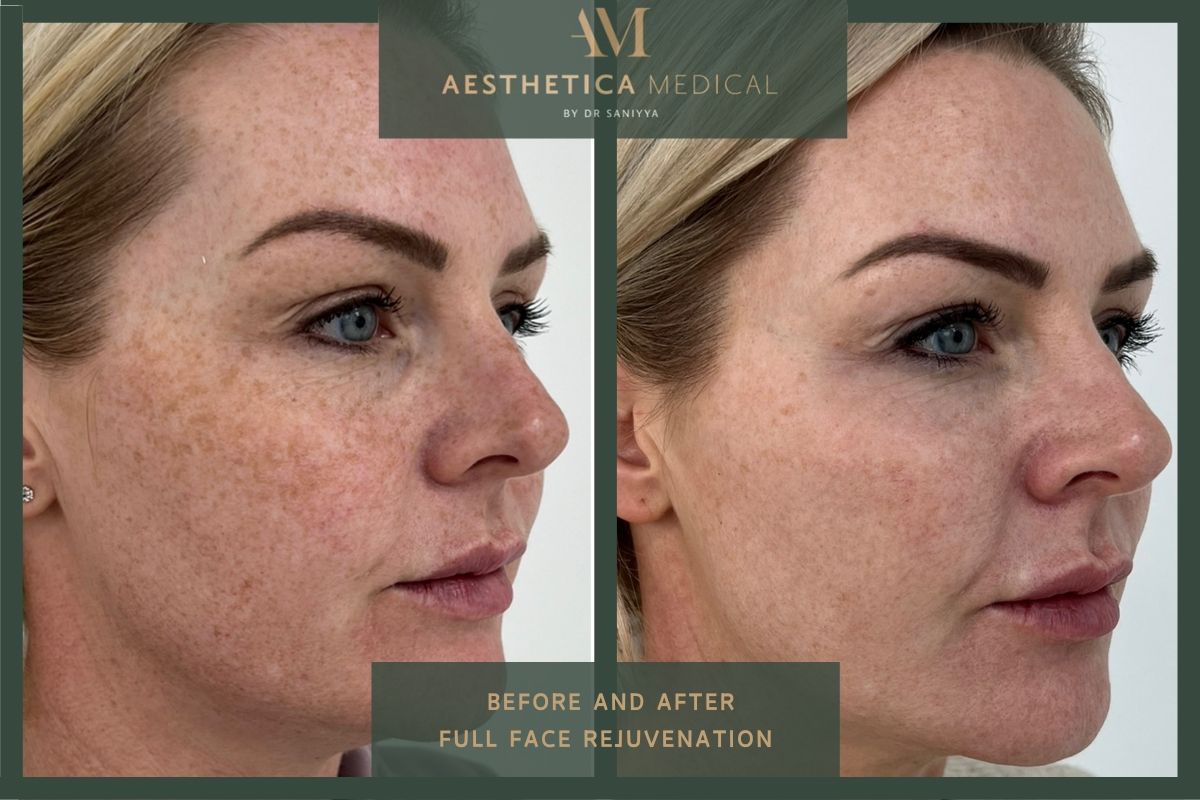 Full face rejuvenation before and after