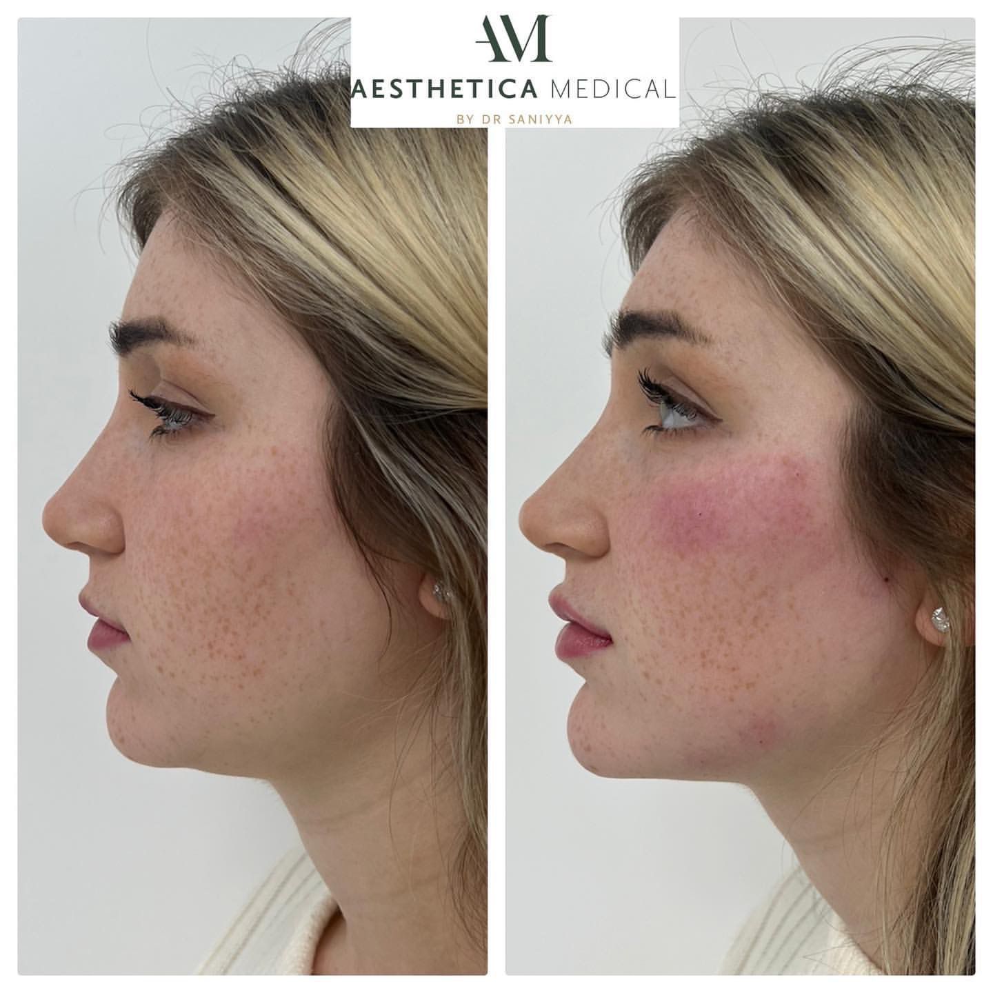 full face rejuvenation before and after photo