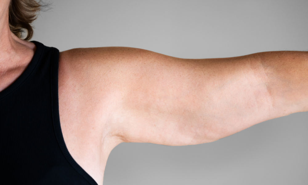 Coolsculpting for arms