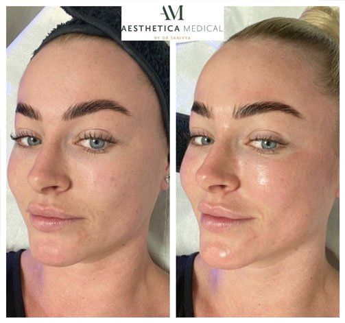 HydraFacial Leeds Best Facial Leeds