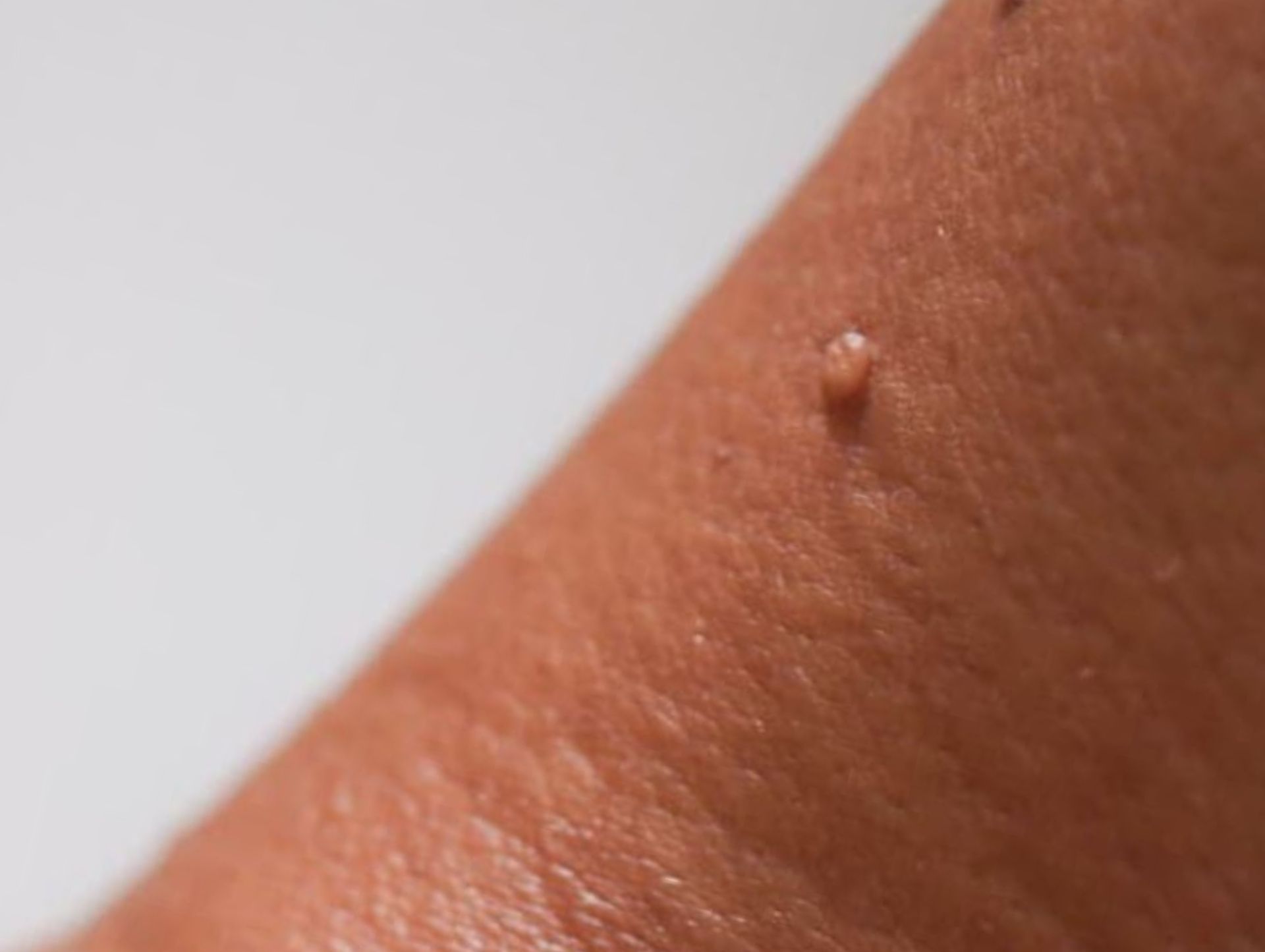 Skin Tag Removal Leeds | Skin Care Solutions