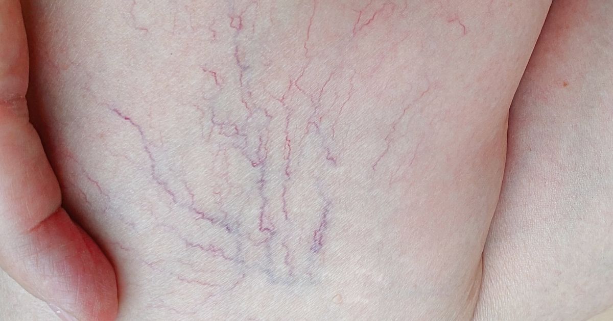 Thread vein removal Leeds