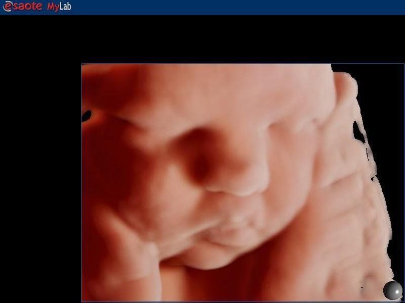 Morphologic ultrasound of the fetus 4D