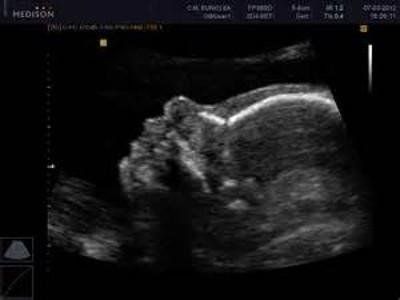 Gynecologic ultrasound