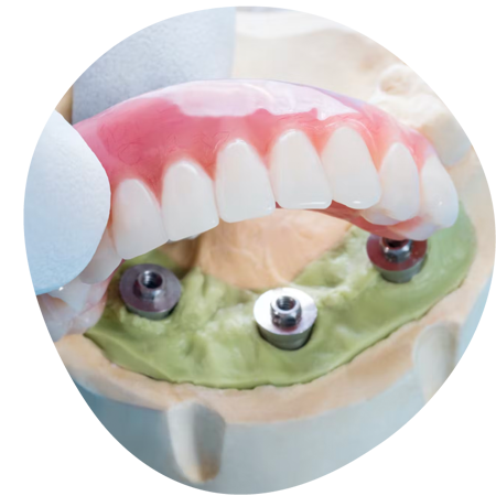 A close up of a denture with screws in it describing the dental service of full mouth reconstruction inJackson NJ and Rockaway NJ