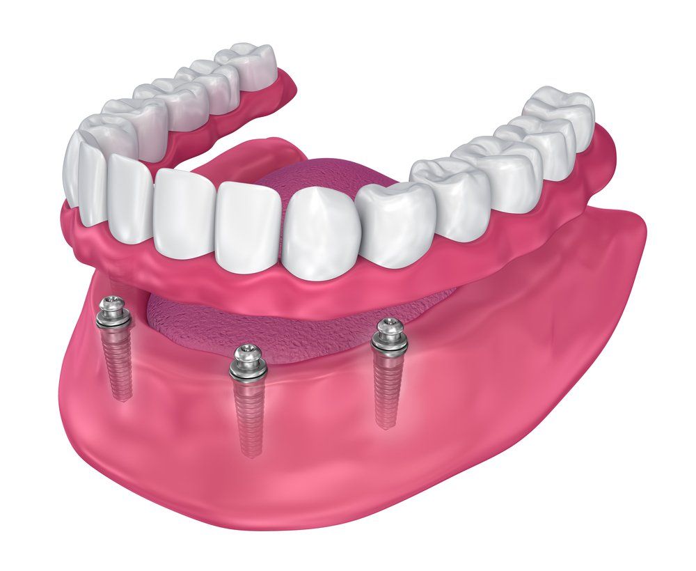 Illustration of dental implants with a complete set of upper and lower dentures in a pink mouth model.