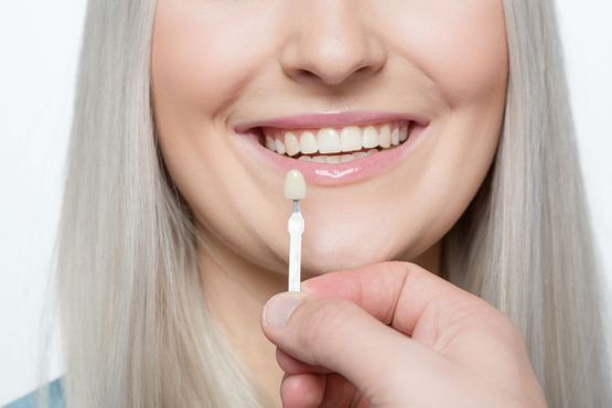 Woman smiling with a dentist holding a tooth shade guide to determine the whiteness of her teeth.