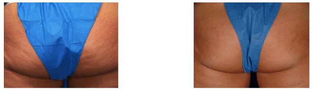Skin Rejuvenation — Before And After An Accent XL Skin Tightening in Tarrant County, TX