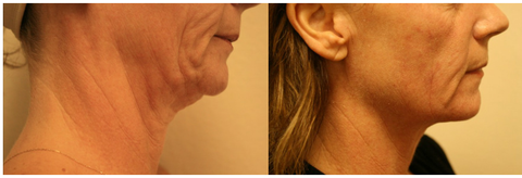 ClearLift™ Laser Facelift — Before And After A ClearLift™ Laser Facelift On Woman in Tarrant County, TX