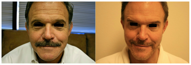 IPL Photo Rejuvenation — Before And After A Facelift Operation On Man in Tarrant County, TX