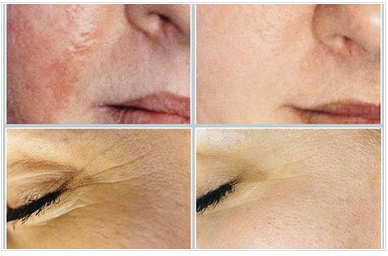 Medical Microderm — Before And After A Medical Microderm At Skin Face in Tarrant County, TX