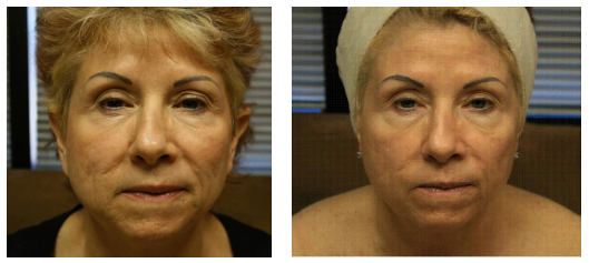 Pixel Skin Resurfacing — Before And After A Pixel Skin Resurfacing On Woman in Tarrant County, TX