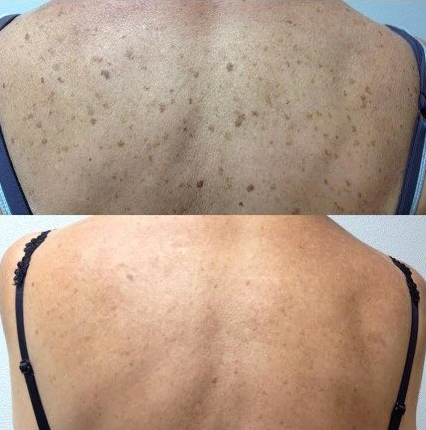 Body Beautification — Before And After A Body Beautification At Back in Tarrant County, TX