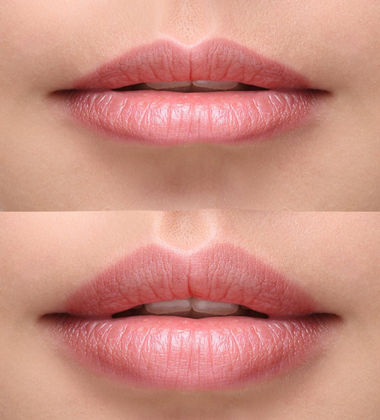 Dermal Fillers — Before And After A Botox Treatment On Lips in Tarrant County, TX