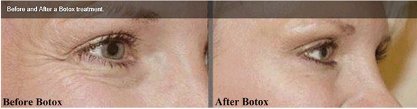 Botox — Before And After A Botox Treatment in Tarrant County, TX