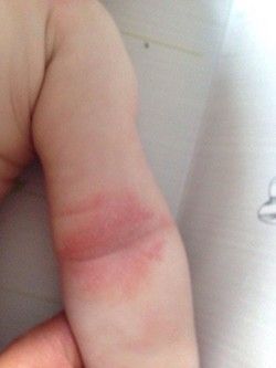 A close up of a baby 's arm with red spots on it.