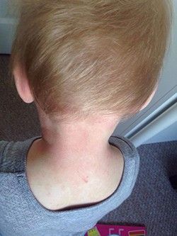 A close up of a child 's head and neck.