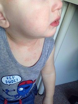 A close up of a toddler 's face with a rash on his chest.
