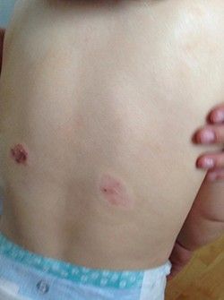 A person is holding a baby 's back with a rash on it.