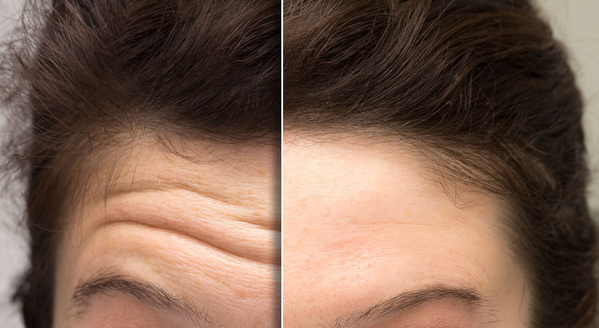 Before and after botox services for smoothing forehead wrinkles and fine expression lines.
