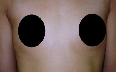 A close up of a person 's chest with two black circles on it.