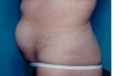 before of a male abdominoplasty 