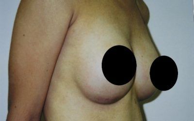 A close up of a person 's chest with two black circles on it.