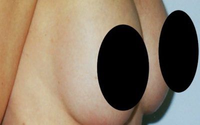 A close up of a person 's chest with two black circles on it.