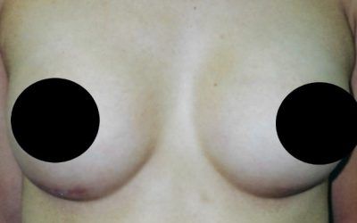 A close up of a person 's chest with two black circles on it.