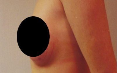 A close up of a person 's chest with two black circles on it.