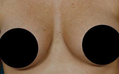 A close up of a person 's chest with two black circles on it.