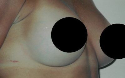 A close up of a person 's chest with two black circles on it.