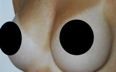 A close up of a person 's chest with two black circles on it.