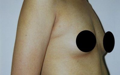 A close up of a person 's chest with two black circles on it.