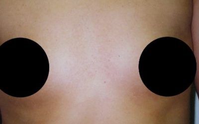 A close up of a person 's chest with two black circles on it.