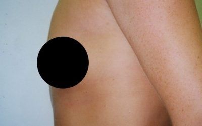 A close up of a person 's chest with two black circles on it.