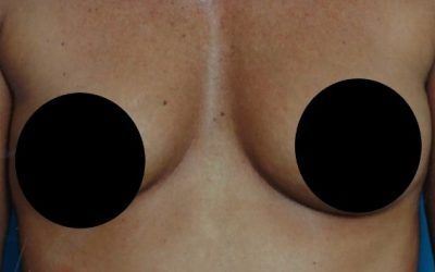 A close up of a person 's chest with two black circles on it.