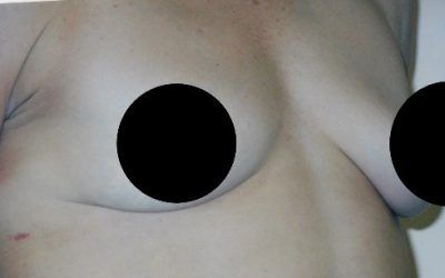 A close up of a person 's chest with two black circles on it.