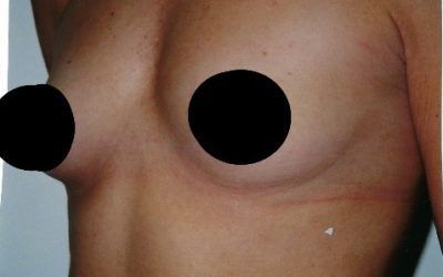 A close up of a person 's chest with two black circles on it.