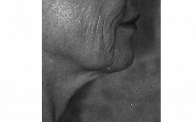 A black and white photo of an elderly woman 's face and neck.