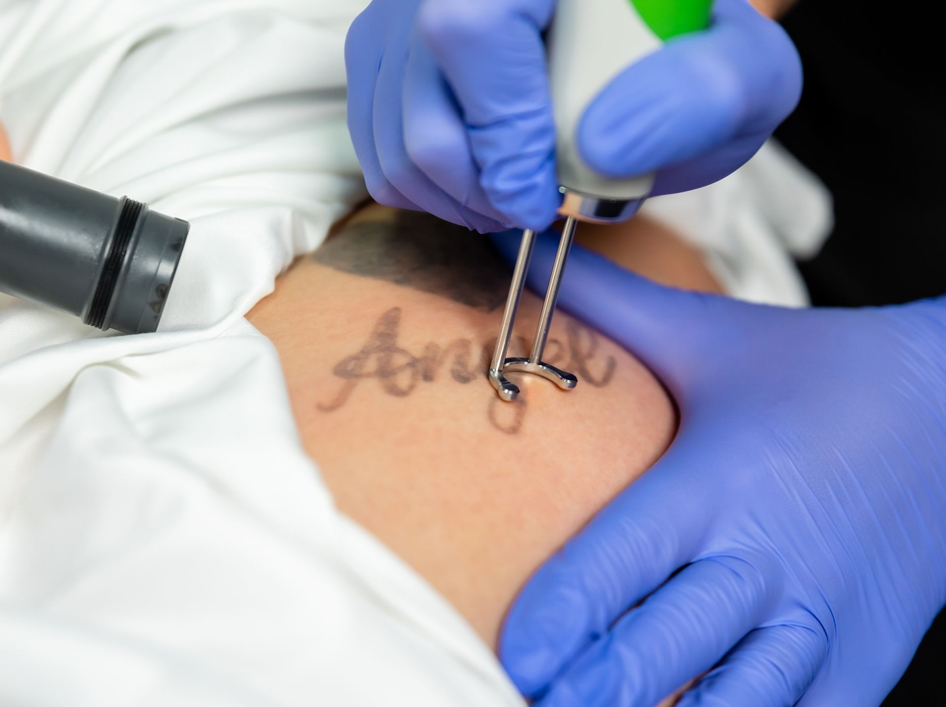 Hands in blue gloves using a laser to remove a tattoo from someone's skin.