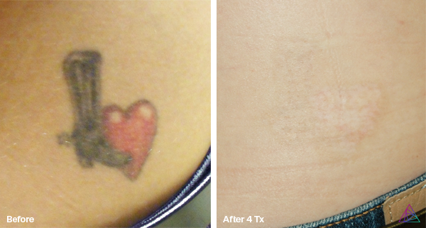 Tattoo removal: Before shows tattoo of a heart and object. After 4 treatments, the skin appears clear with slight scarring.
