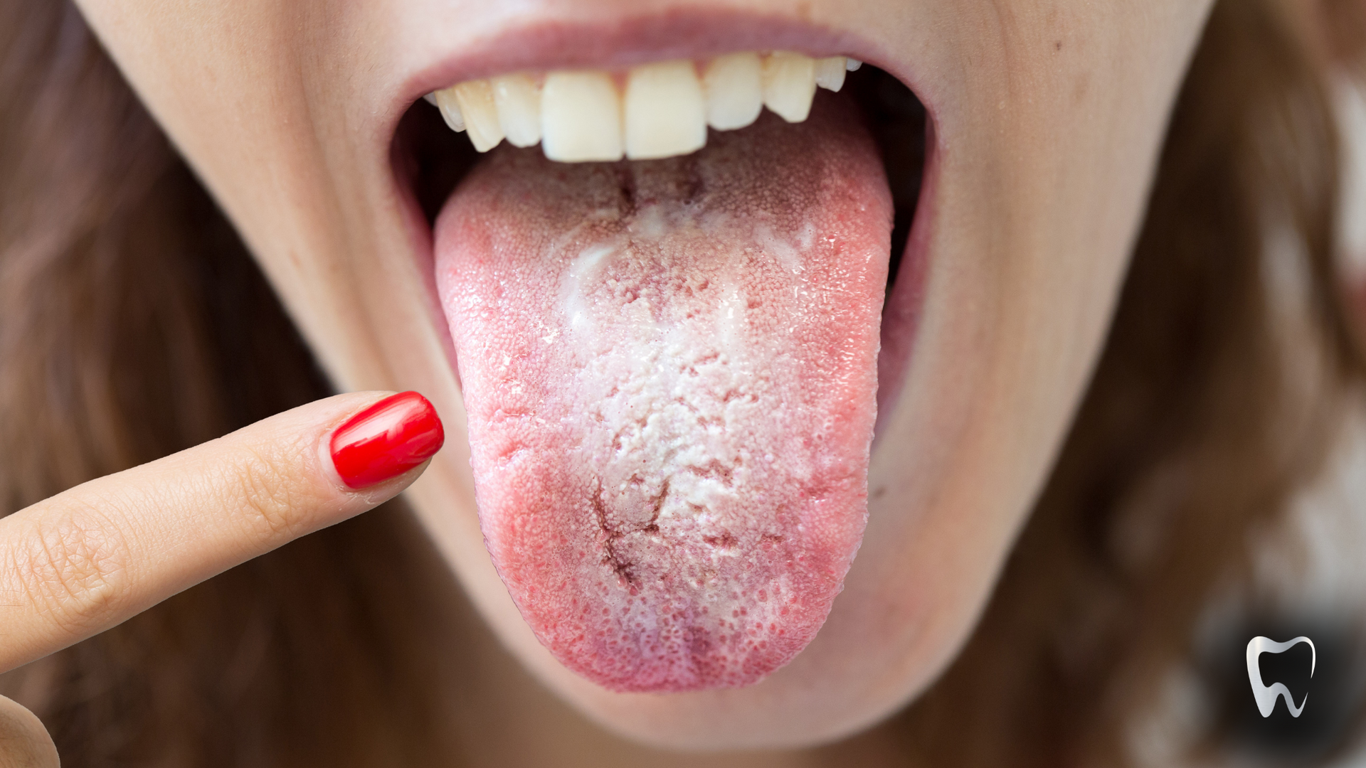 A close up of a woman 's tongue with white spots on it.