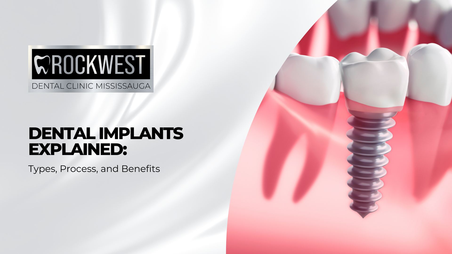 Dental implant illustration with a Rockwest Dental logo; explaining types, process, and benefits.