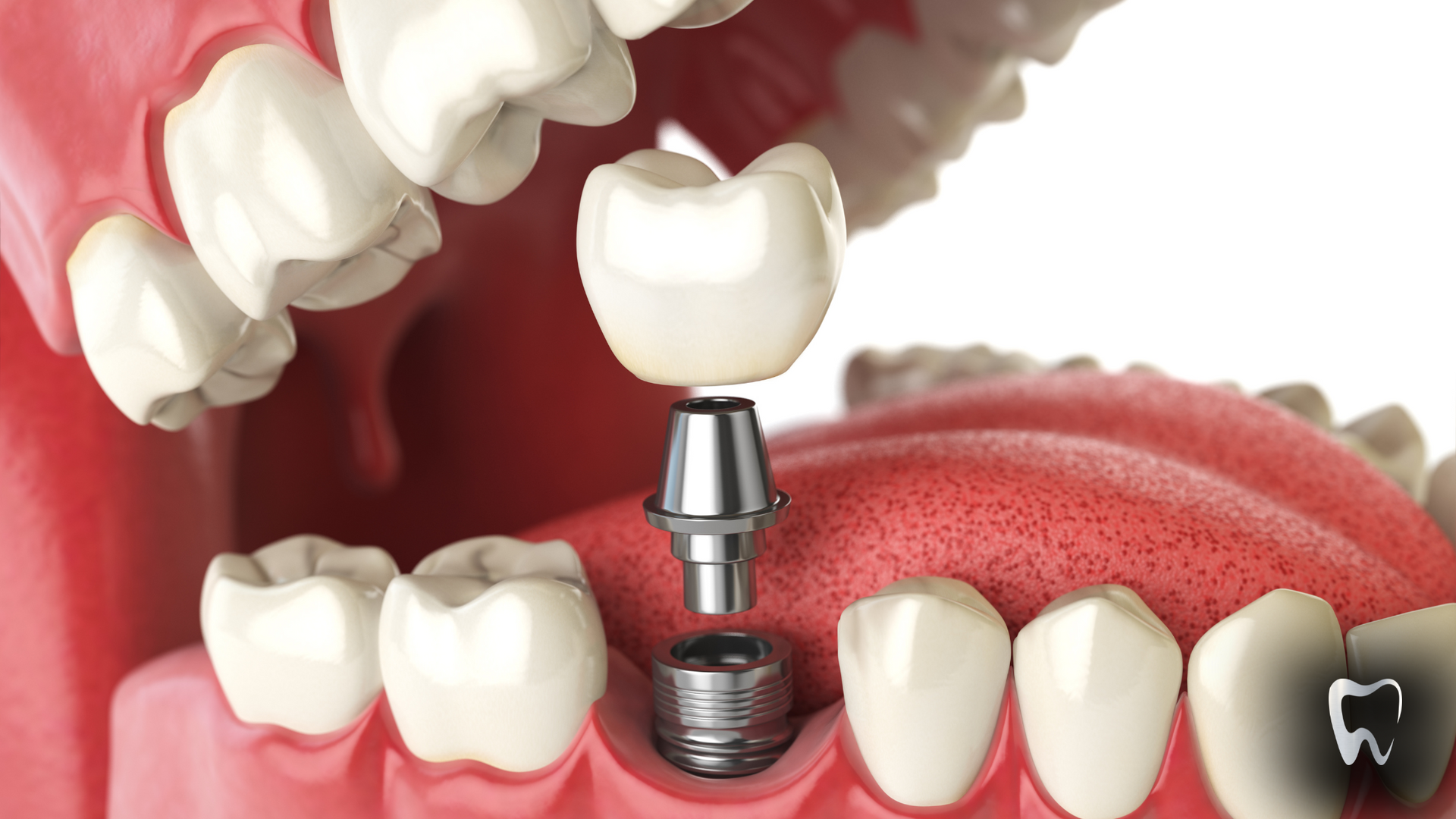 A close up of a dental implant in a person 's mouth.