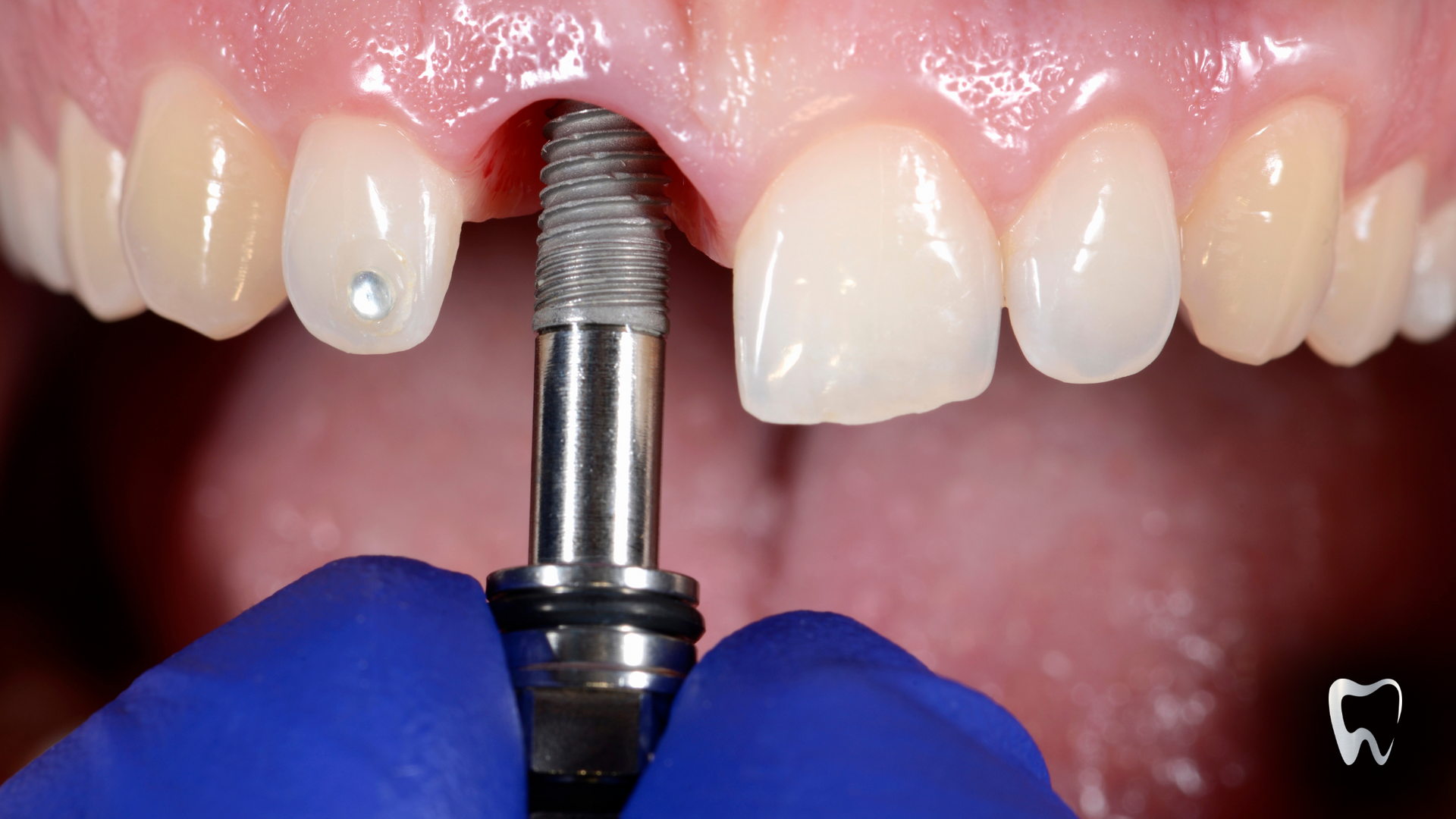 A person is holding a dental implant in their mouth.