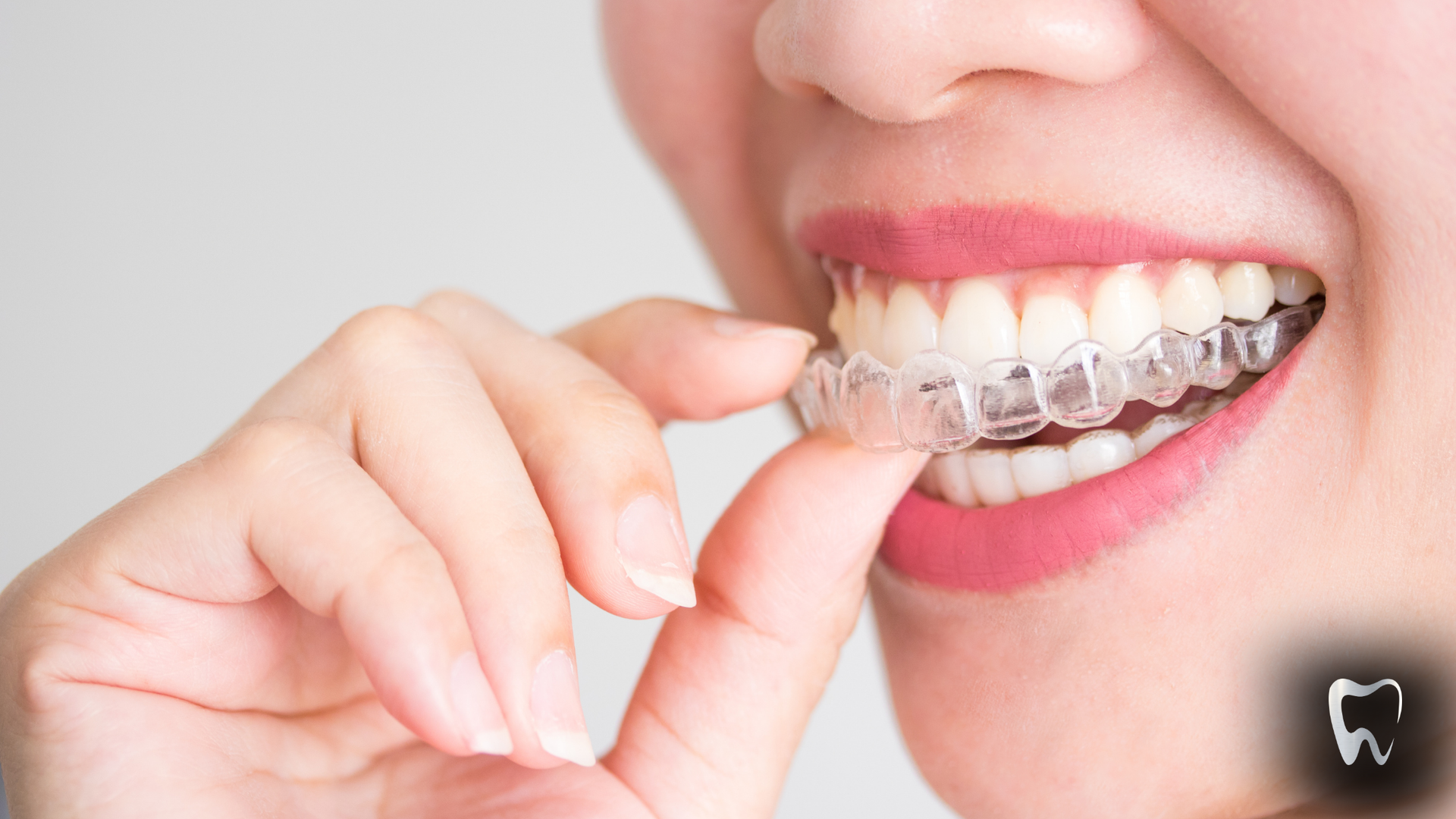 Woman inserts clear aligner into her mouth, dental care concept.