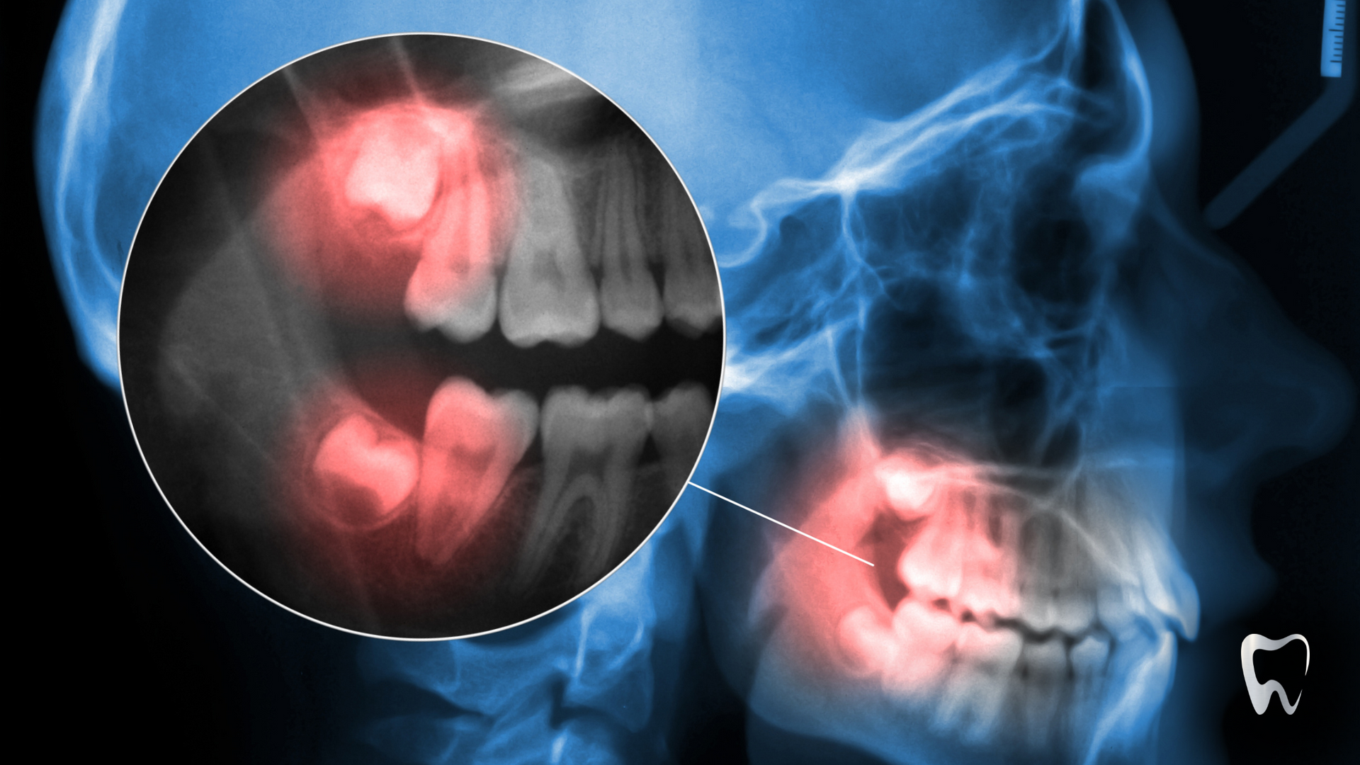 A close up of an x-ray of a person 's teeth showing a tooth with a hole in it.